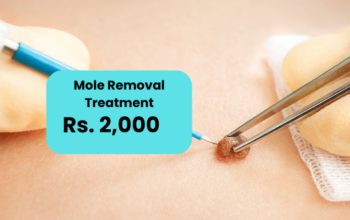 Mole Removal Treatment Cost in Islamabad Pakistan