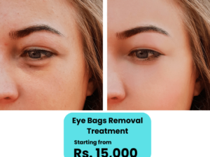 Eye Bag Removal Nonsurgical Treatment in Islamabad