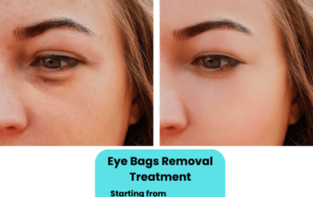 Eye Bag Removal Nonsurgical Treatment in Islamabad