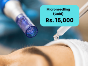 Microneedling for Melasma in Islamabad Lahore