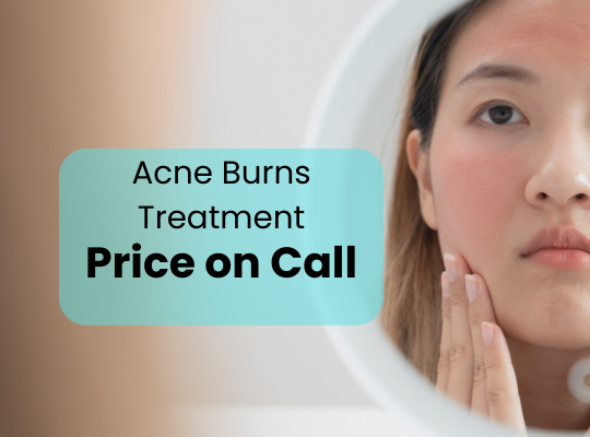 Acne Burns Treatment in Islamabad Rawalpindi